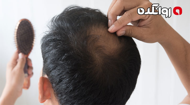 آیا استرس باعث ریزش مو میشود
