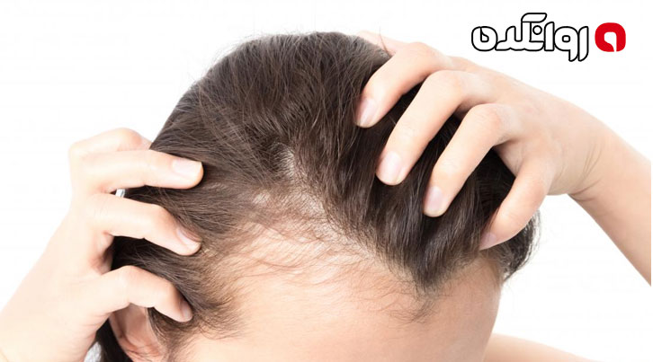 دارو برای ریزش مو ناشی از استرس